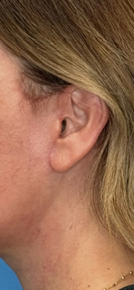 Deep Plane Facelift (ContourLift) Real Patient Incision Location | Orange County Surgical Specialists