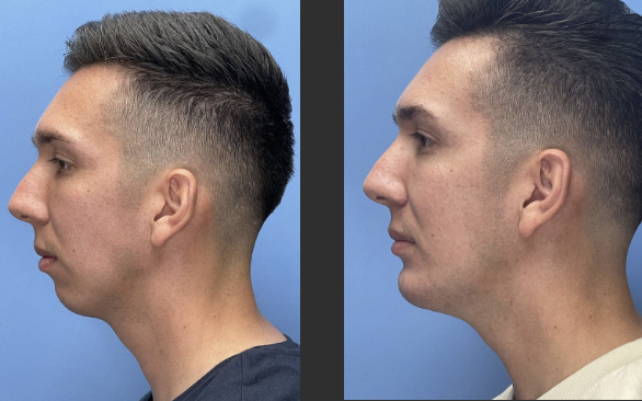 The Power of a Simple Chin Implant | Orange County Surgical Specialists