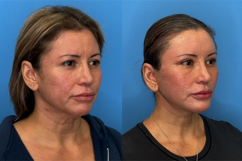 The Truth About Facelift Myth vs. Fact