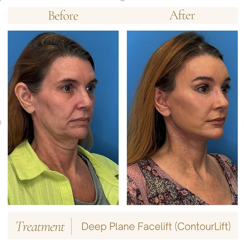 The Truth About Facelift Myth vs. Fact