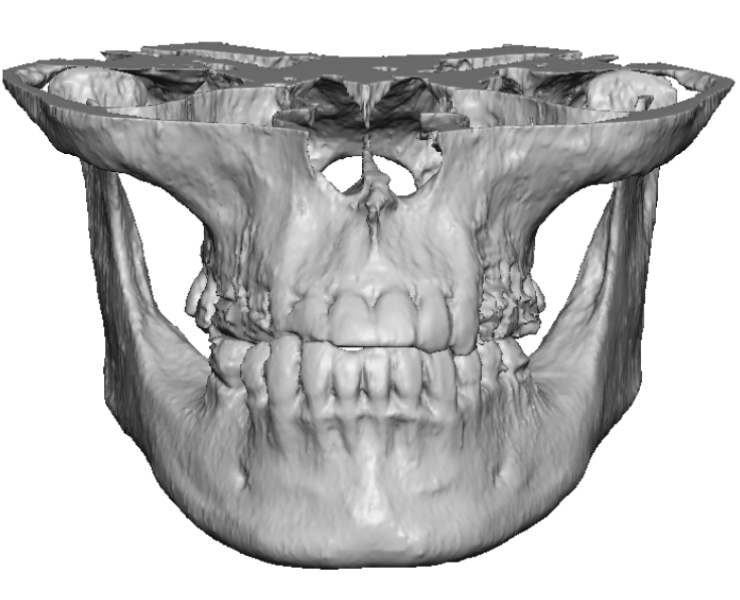 Jaw Implants Mission Viejo, Ca 