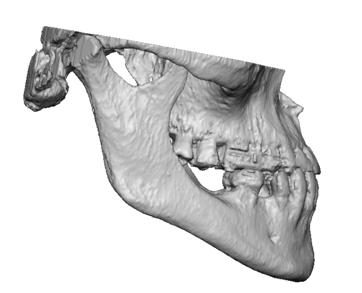 Jaw Implants Mission Viejo, CA | Orange County Surgical Specialists