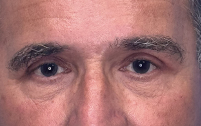 Blepharoplasty Before & After Image