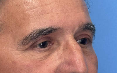 Blepharoplasty Before & After Image