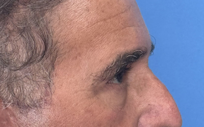 Blepharoplasty Before & After Image