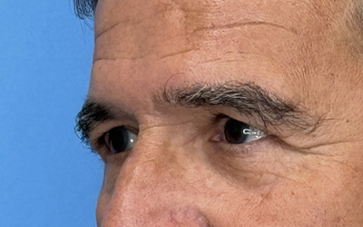 Blepharoplasty Before & After Image