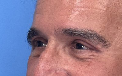 Blepharoplasty Before & After Image