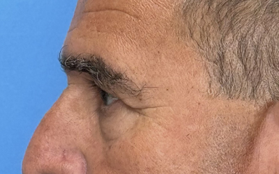 Blepharoplasty Before & After Image