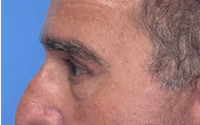 Blepharoplasty Before & After Image