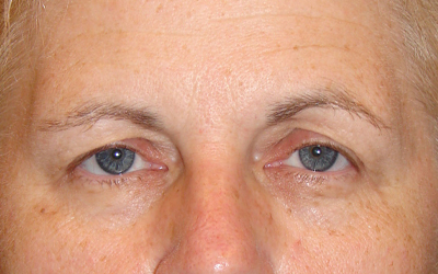 Blepharoplasty Before & After Image