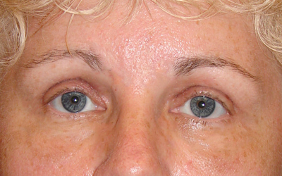 Blepharoplasty Before & After Image