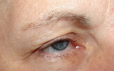 Blepharoplasty Before & After Image