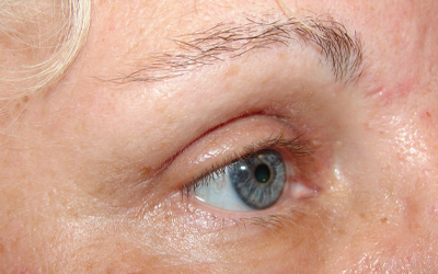 Blepharoplasty Before & After Image