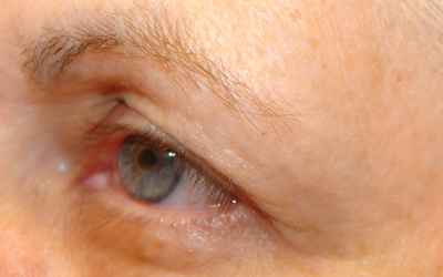 Blepharoplasty Before & After Image