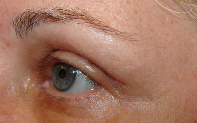 Blepharoplasty Before & After Image