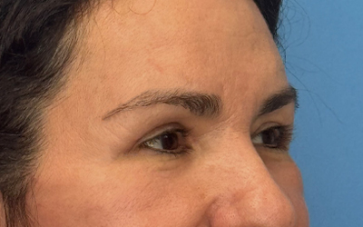 Blepharoplasty Before & After Image