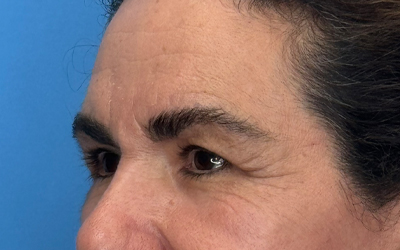 Blepharoplasty Before & After Image