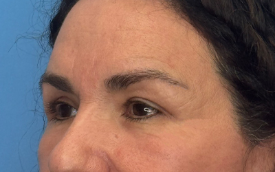 Blepharoplasty Before & After Image