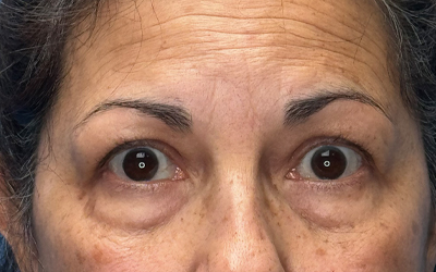 Blepharoplasty Before & After Image