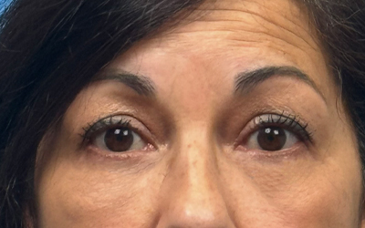 Blepharoplasty Before & After Image