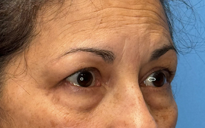 Blepharoplasty Before & After Image