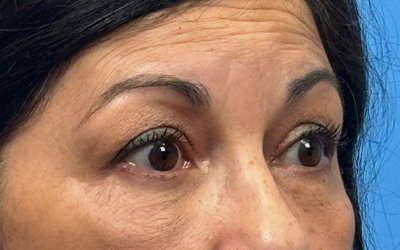 Blepharoplasty Before & After Image