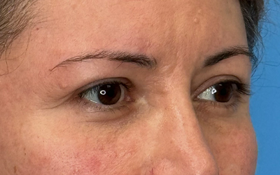 Blepharoplasty Before & After Image