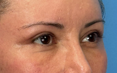 Blepharoplasty Before & After Image