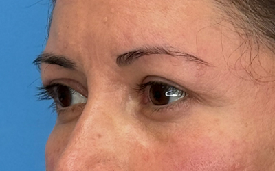 Blepharoplasty Before & After Image