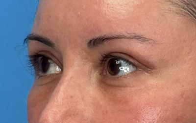 Blepharoplasty Before & After Image