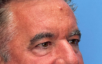 Blepharoplasty Before & After Image