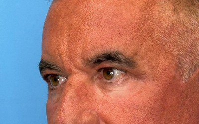 Blepharoplasty Before & After Image