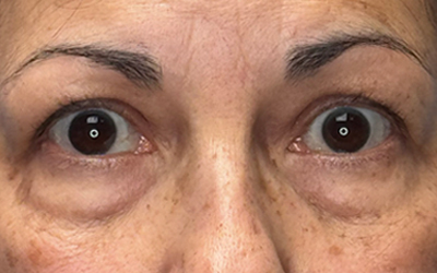 Blepharoplasty Before & After Image