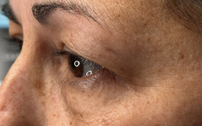 Blepharoplasty Before & After Image