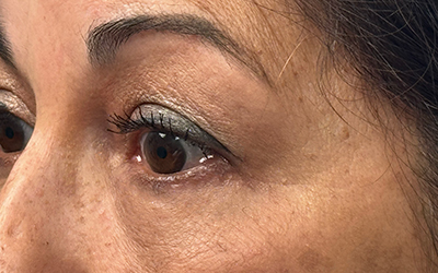 Blepharoplasty Before & After Image