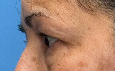 Blepharoplasty Before & After Image