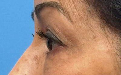 Blepharoplasty Before & After Image