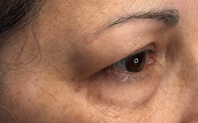 Blepharoplasty Before & After Image