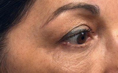 Blepharoplasty Before & After Image