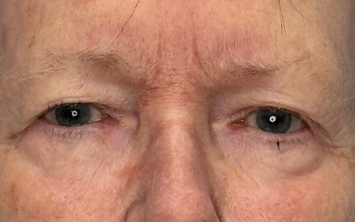 Blepharoplasty Before & After Image