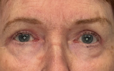 Blepharoplasty Before & After Image