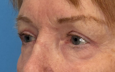 Blepharoplasty Before & After Image