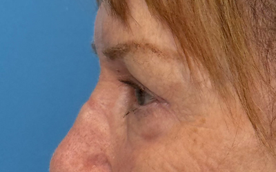 Blepharoplasty Before & After Image