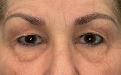 Blepharoplasty Before & After Image