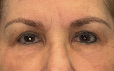 Blepharoplasty Before & After Image