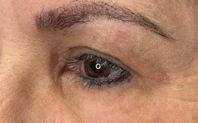 Blepharoplasty Before & After Image