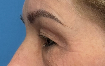 Blepharoplasty Before & After Image