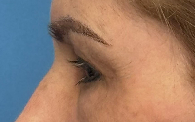 Blepharoplasty Before & After Image