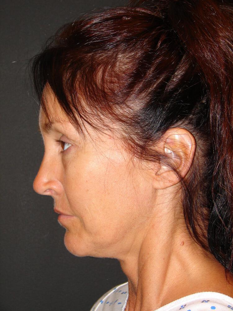 Deep Plane Facelift (Contour Lift) Before & After Image