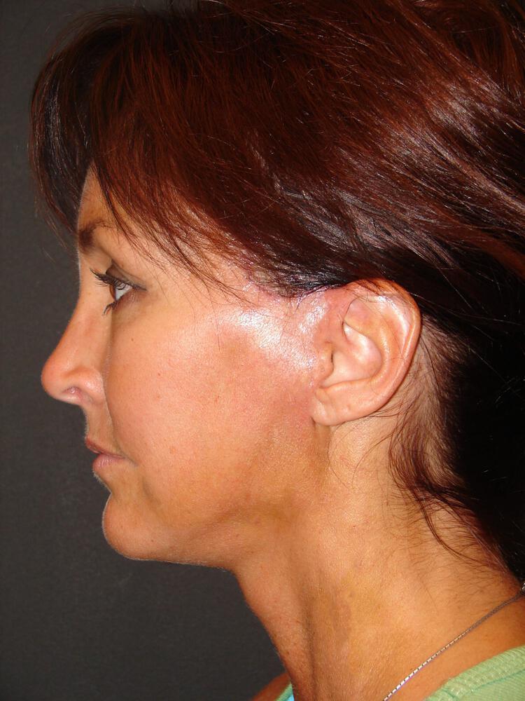 Deep Plane Facelift (Contour Lift) Before & After Image